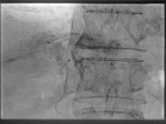 2 TACE术中.gif