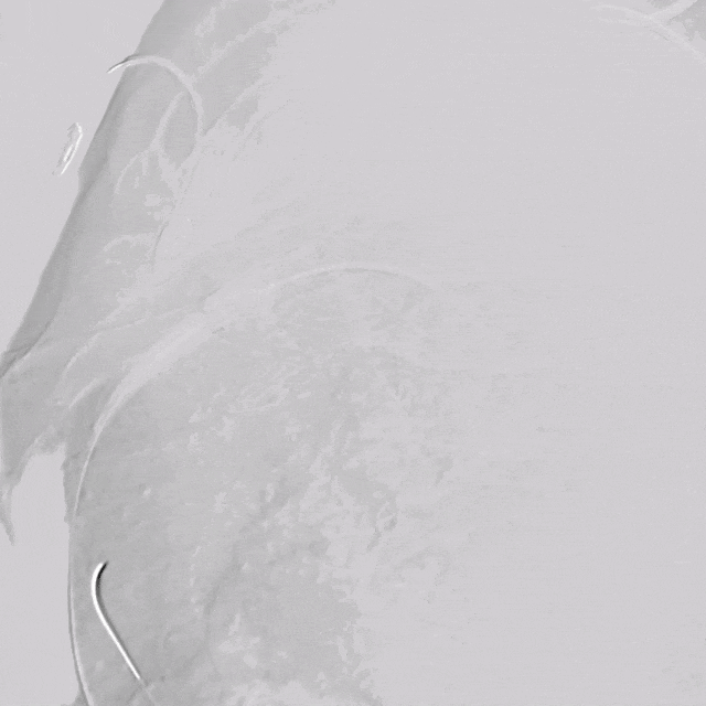 undefined 7、LSA可调弯鞘造影.gif