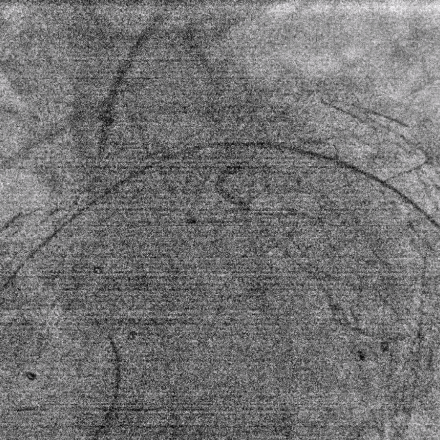 undefined 4、V-18导丝顺利穿膜开窗.gif