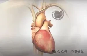 Orchestra BioMed BackBeat cardiac neuromodulation therapy