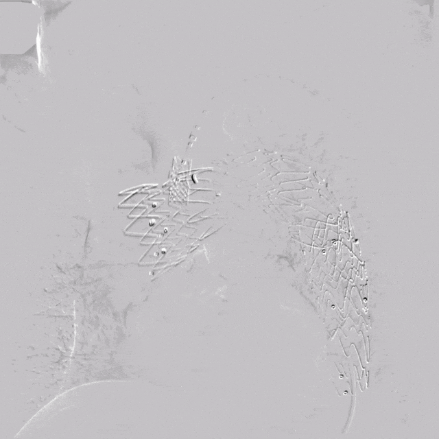 undefined 8术后造影.gif
