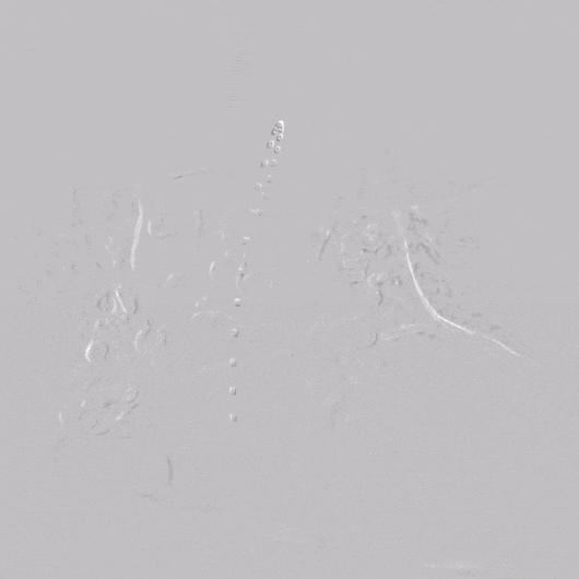 undefined 2、胸主术前造影.gif