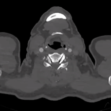 undefined 术前CTA横断面.gif