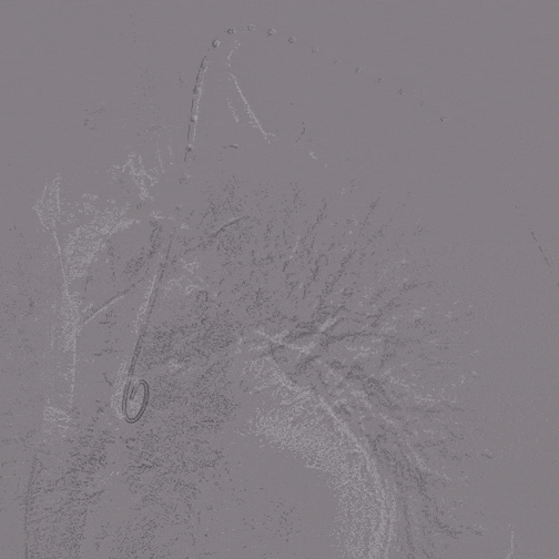 undefined 1、术前胸主造影1.gif