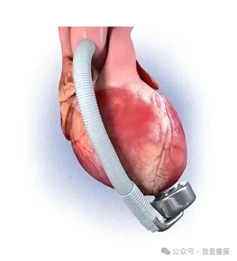 CorWave LVAD - CorWave FR
