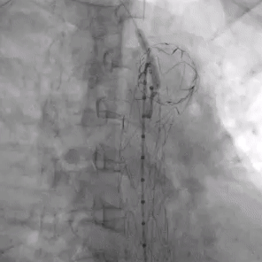 undefined 5小球囊扩张开窗口.gif