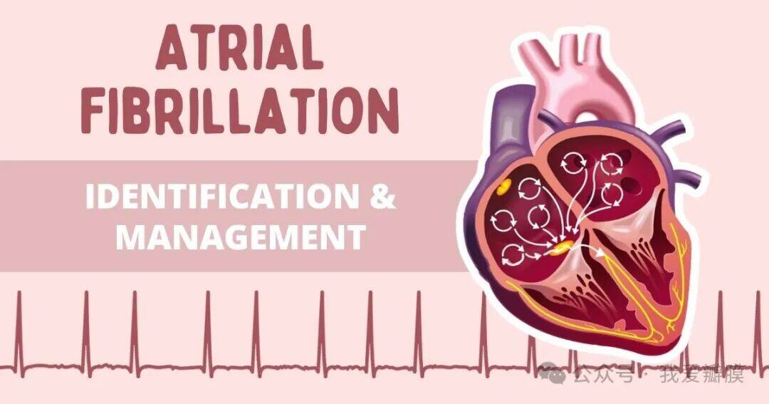 Afib With Rvr Treatment