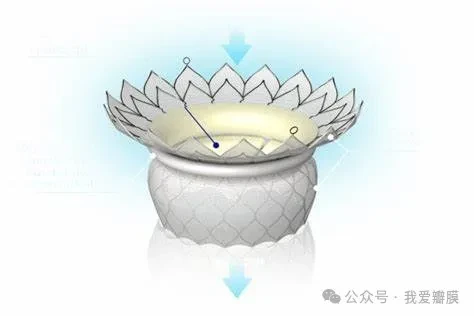 TSMVR by HighLife - Trans-Septal Mitral Valve Replacement