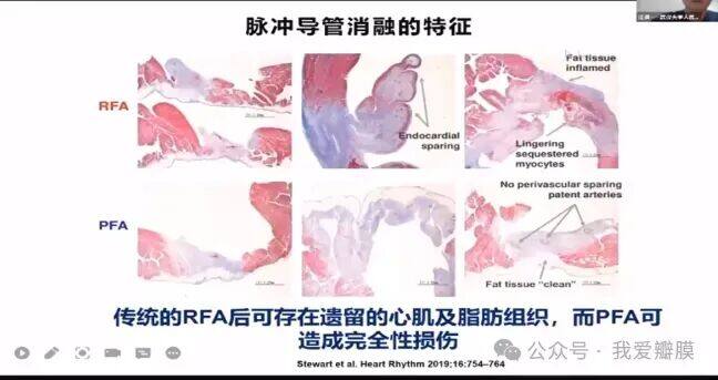 聚焦·PFA丨江洪:房颤治疗的新技术变革——脉冲电场导管消融 -- 严道医声网