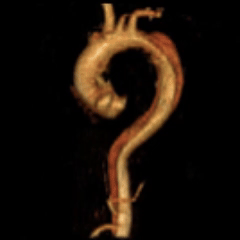undefined 术前三维.gif