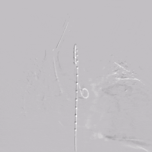 undefined 9术前造影RAO.gif