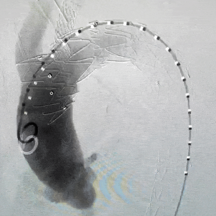 undefined 9 术后造影.gif