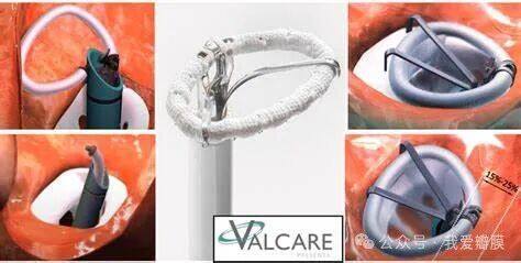 The AMEND ring. Courtesy of Valcare Medical | Download Scientific Diagram