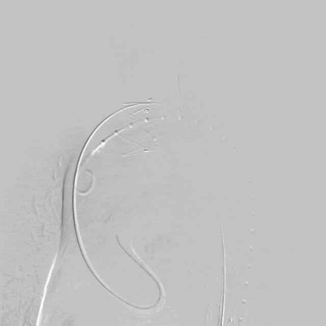 9 最后造影.gif