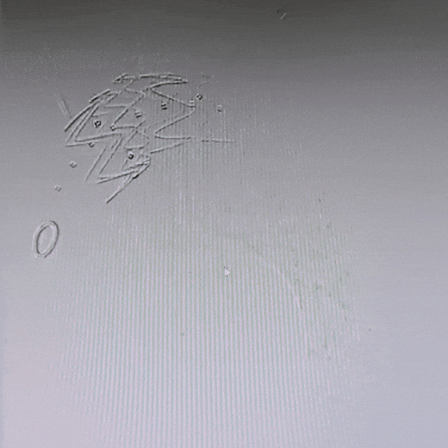 undefined 8 术后造影.gif