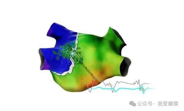 CARTO™ 3 系统版本 8 具有新模块,包括 CARTO ELEVATE™ 模块和 CARTOSOUND™ FAM 模块,专为电生理学家执行导管消融手术的效率、可重复性和准确性而设计。