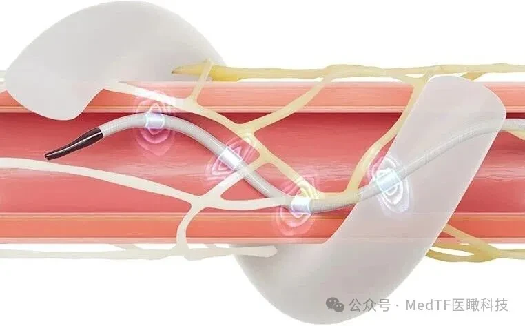 Medtronic data highlights clinical benefit of Symplicity Spyral RDN