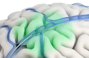 An illustration showing a neurological device, the Synchron Stentrode brain implant sensing motor signals.
