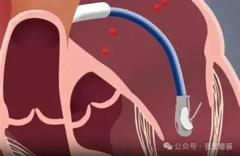 Nyra Medical initiates first-in-human study of heart implant