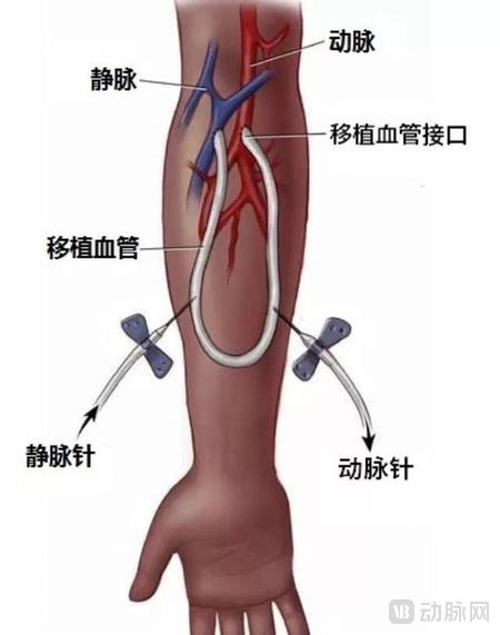 内瘘手术.jpg