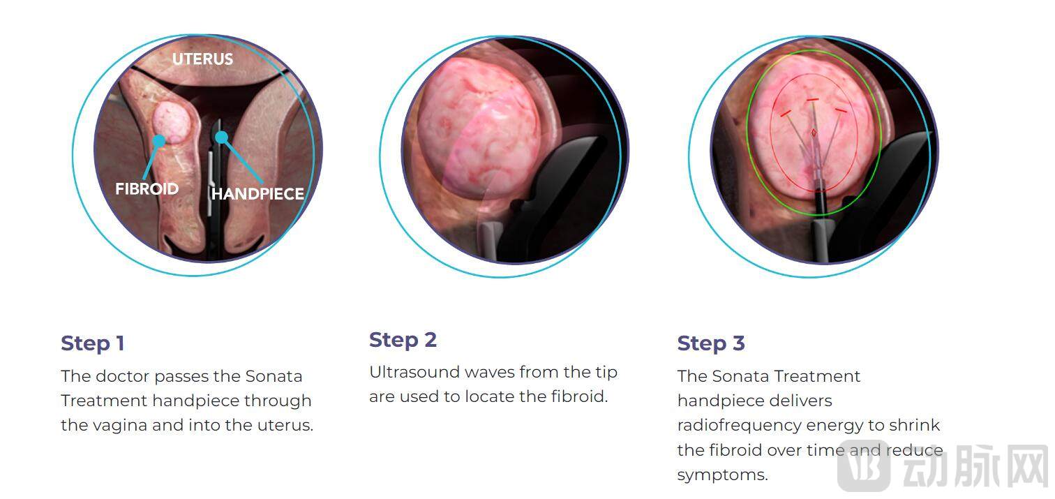 Sonata系统手术操作流程 图源Gynesonics官网.jpg