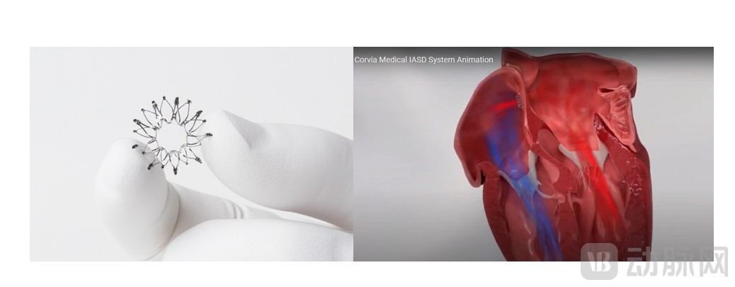心房分流器.png