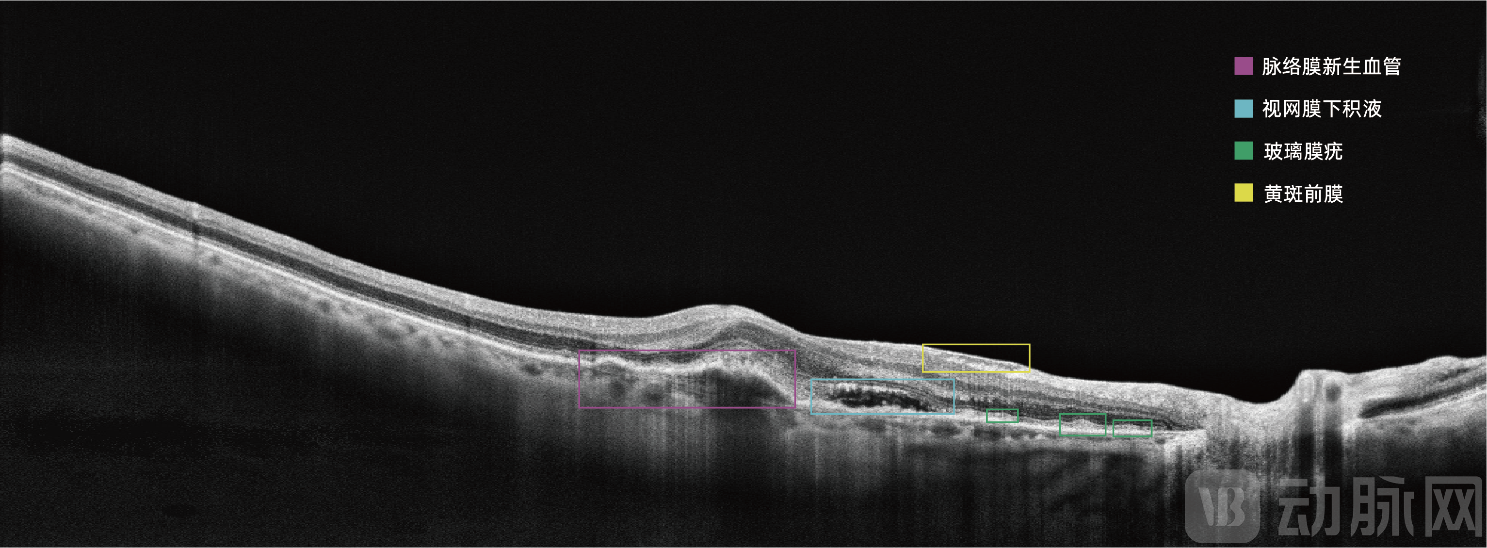 AI OCT病症图例(精准AI帮助发现细微病变).png