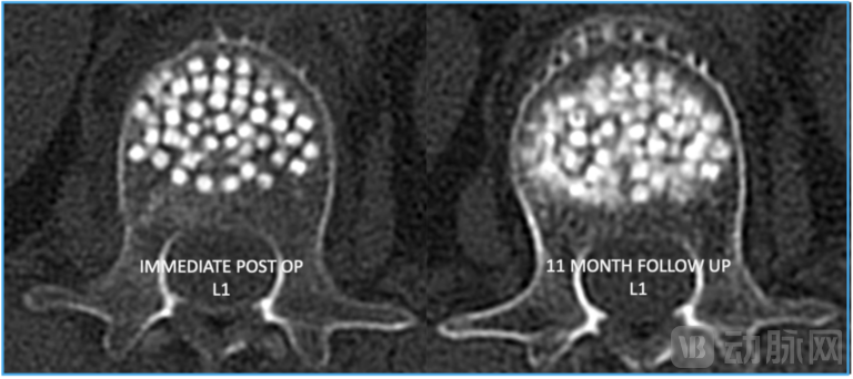 右侧的图形显示的是 OsteoPearl 植入物 11 个月后的情况。边缘模糊的部分显示了新骨正在最需要的地方形成。.png