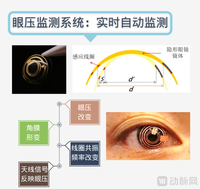 眼压监测图.png