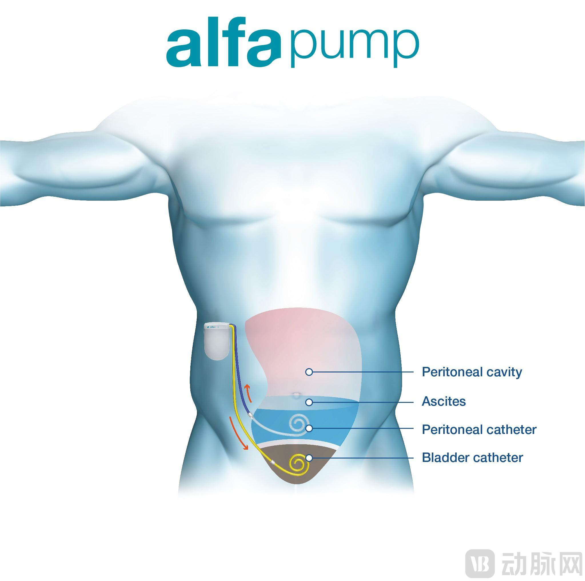 alfa Pump ®通过微创手术植入.jpg