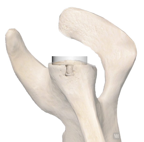 inset-glenoid-bone-preservation-transparent-bg.png