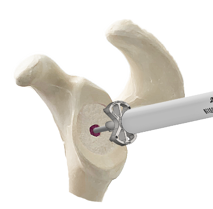 inset-glenoid-reamer.png