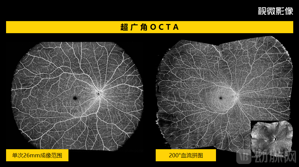 视微影像OCTA.png