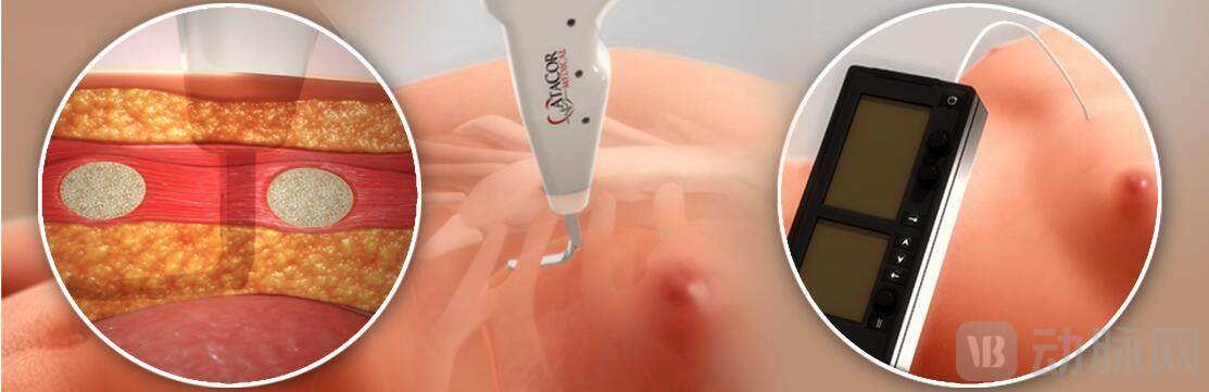 AtaCor EV 临时起搏导线系统采用专有的胸骨旁方法.jpg