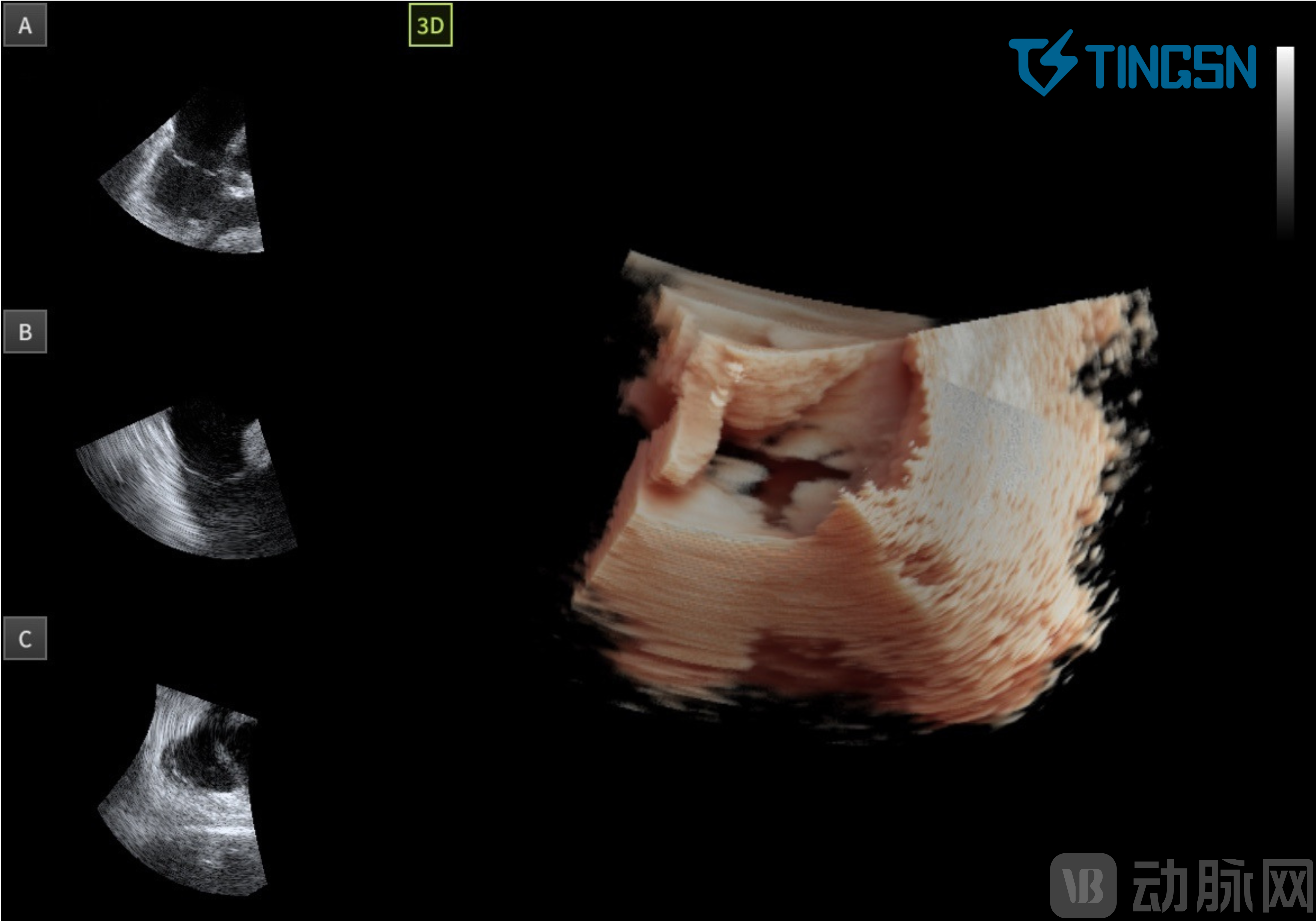 3 心室收缩期 三尖瓣瓣叶呈闭合状态.png
