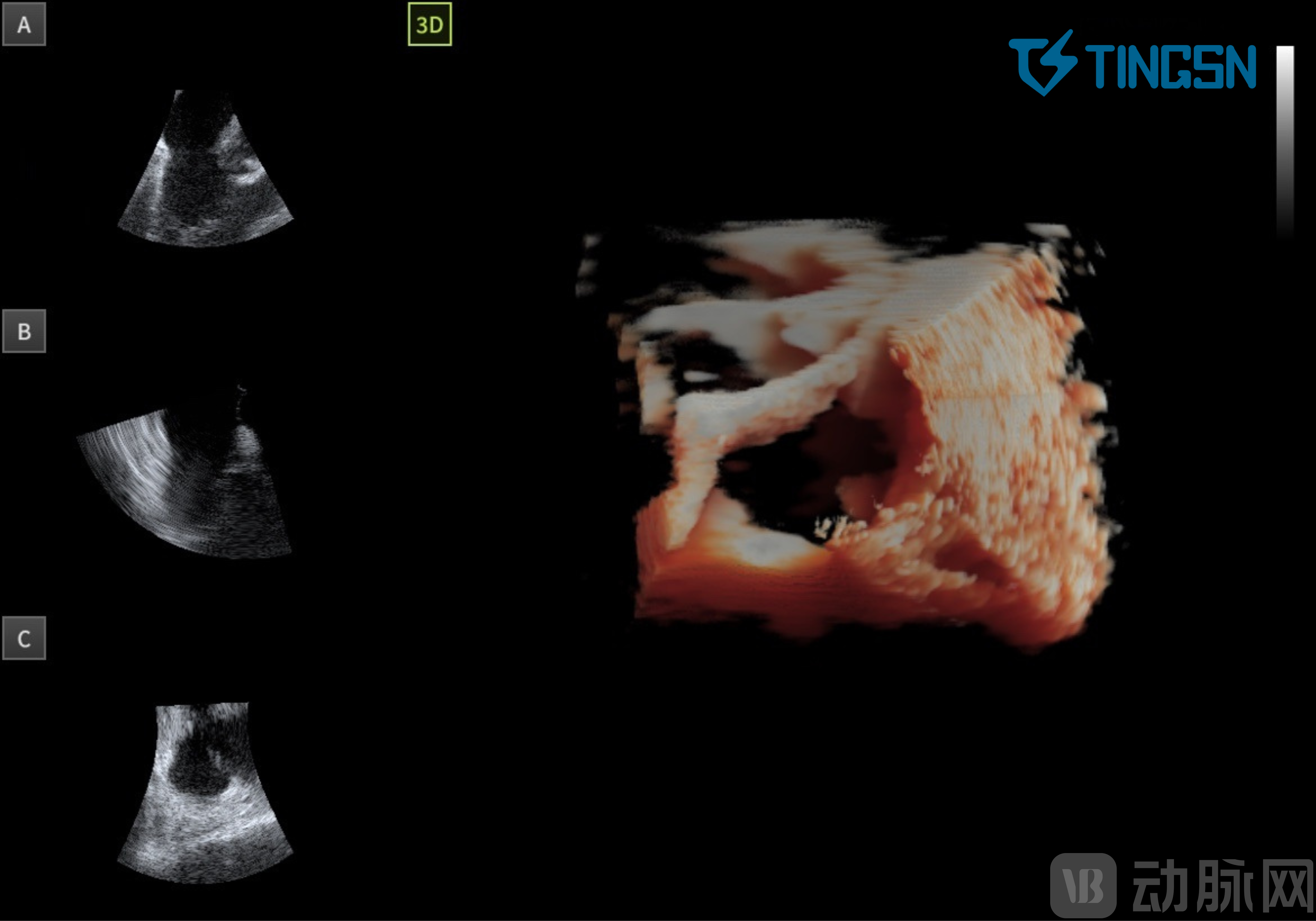 4 心室舒张期 三尖瓣瓣叶呈开放状态.png
