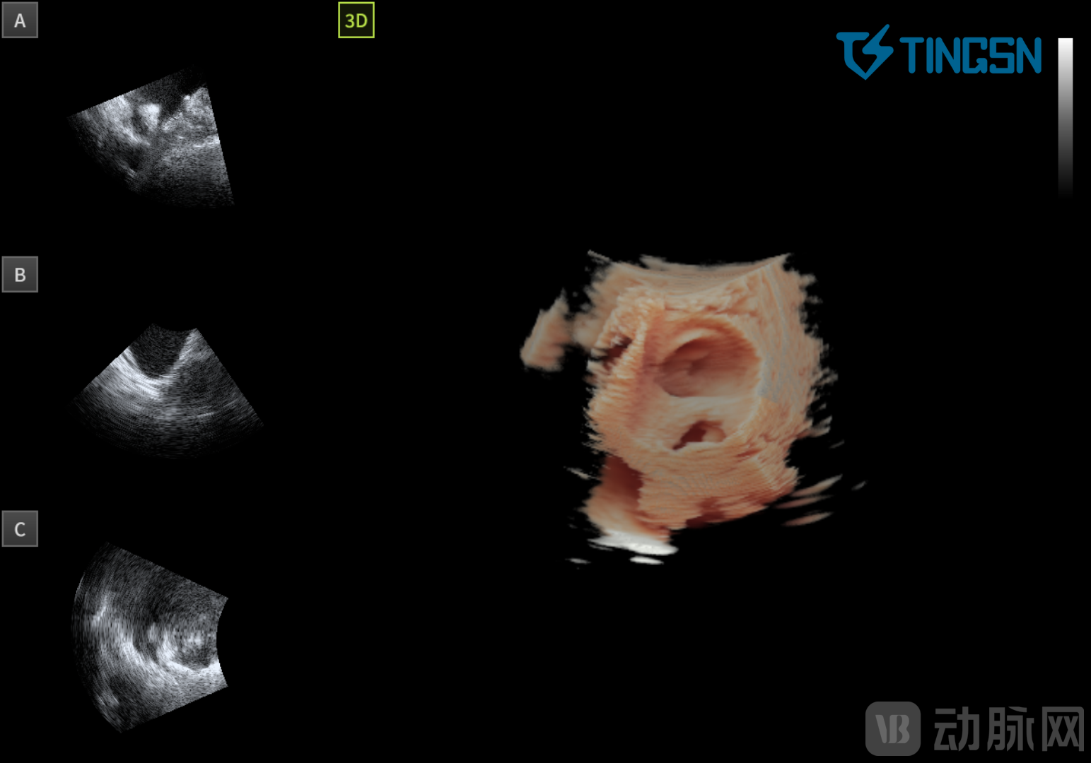 5 左心耳内放置封堵器.png