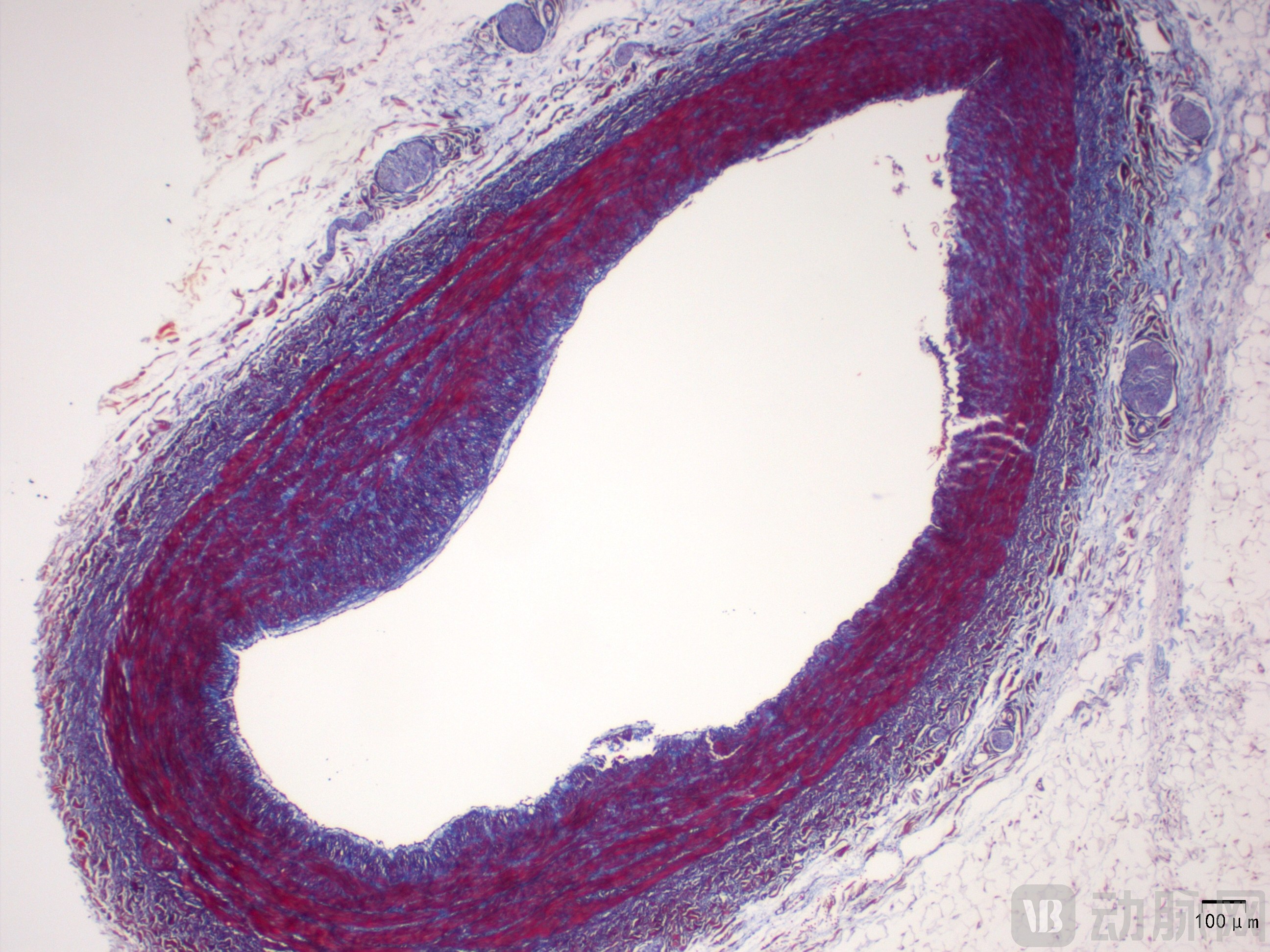 血管球切片图片