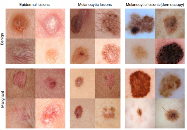 skin-colored-blotch-lesions-640x444.png