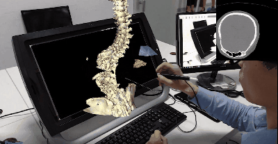 图2 – mVR虚拟现实手术规划系统处理脊柱的临床案例.gif