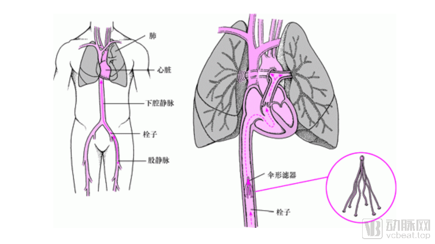 下腔静脉滤器预防肺栓塞.PNG