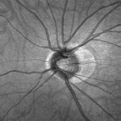 视盘区下层视网膜-脉络膜重建.jpg